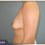 Breast Lift with Augmentation Before & After Patient #499