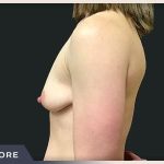 Breast Lift with Augmentation Before & After Patient #497