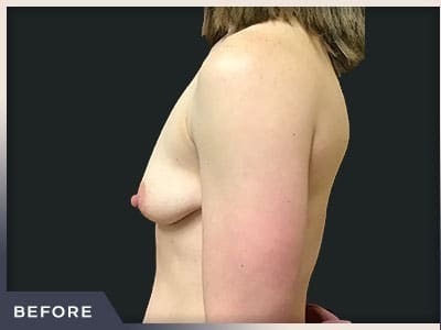 Breast Lift with Augmentation Before & After Patient #497