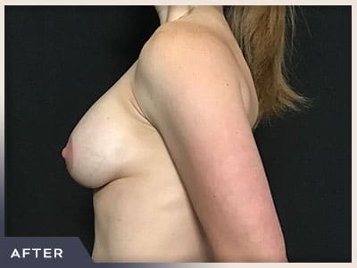 Breast Lift with Augmentation Before & After Patient #497