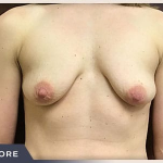 Breast Lift with Augmentation Before & After Patient #497