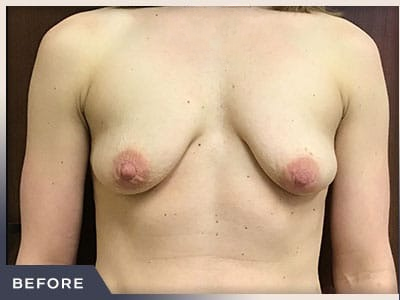 Breast Lift with Augmentation Before & After Patient #497