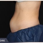 CoolSculpting Before & After Patient #766