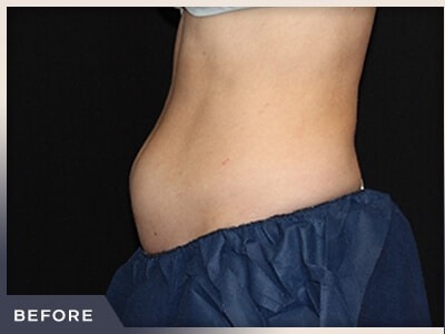 CoolSculpting Before & After Patient #766