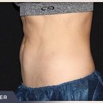 CoolSculpting Before & After Patient #766