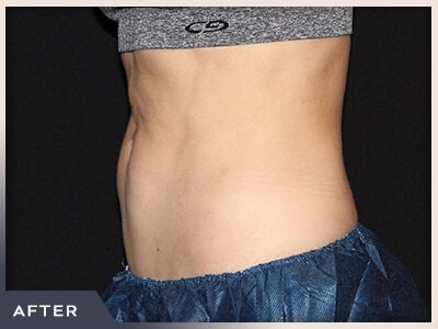 CoolSculpting Before & After Patient #766