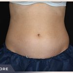CoolSculpting Before & After Patient #766