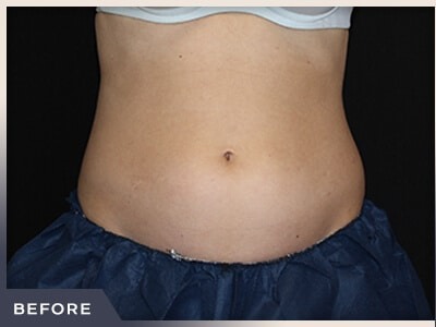 CoolSculpting Before & After Patient #766
