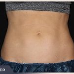 CoolSculpting Before & After Patient #766