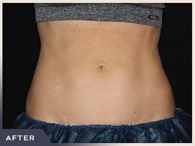 CoolSculpting Before & After Patient #766