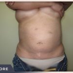 Liposuction Before & After Patient #767