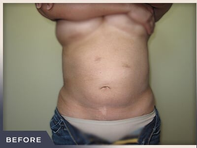 Liposuction Before & After Patient #767