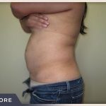 Liposuction Before & After Patient #767