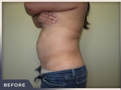 Liposuction Before & After Patient #767