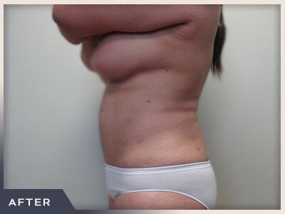 Liposuction Before & After Patient #767
