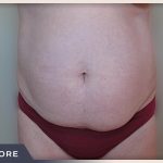 Liposuction Before & After Patient #768