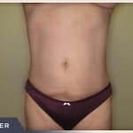 Liposuction Before & After Patient #768