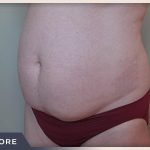 Liposuction Before & After Patient #768