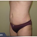 Liposuction Before & After Patient #768