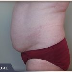 Liposuction Before & After Patient #768