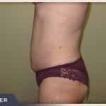 Liposuction Before & After Patient #768