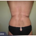 Liposuction Before & After Patient #769