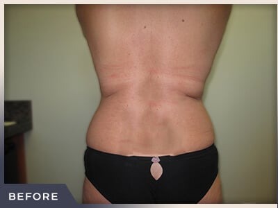 Liposuction Before & After Patient #769