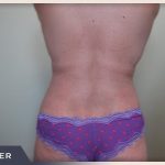 Liposuction Before & After Patient #769