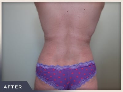 Liposuction Before & After Patient #769