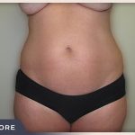 Liposuction Before & After Patient #769