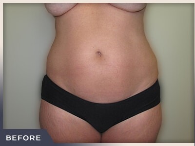 Liposuction Before & After Patient #769