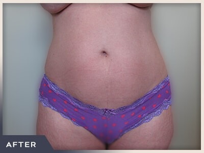 Liposuction Before & After Patient #769