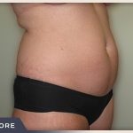Liposuction Before & After Patient #769