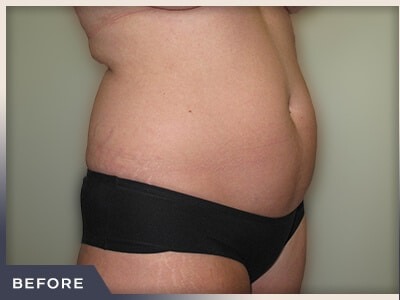 Liposuction Before & After Patient #769