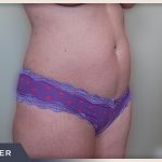 Liposuction Before & After Patient #769