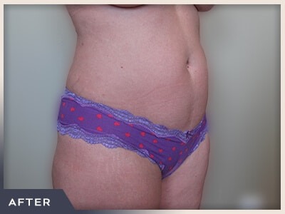 Liposuction Before & After Patient #769