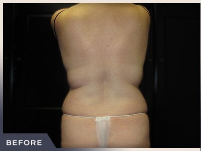 Liposuction Before & After Patient #770