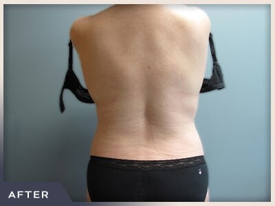 Liposuction Before & After Patient #770