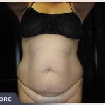 Liposuction Before & After Patient #770