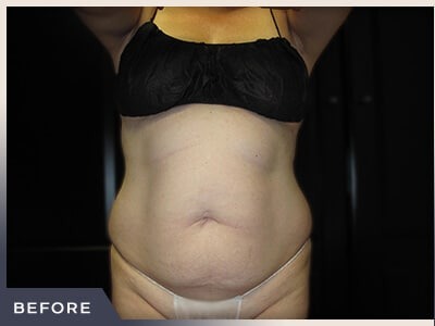 Liposuction Before & After Patient #770