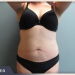 Liposuction Before & After Patient #770