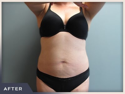 Liposuction Before & After Patient #770