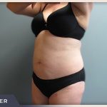 Liposuction Before & After Patient #770