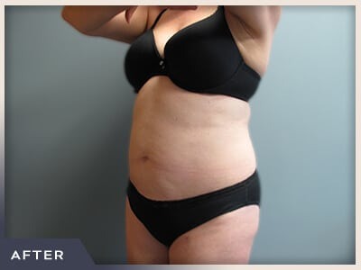 Liposuction Before & After Patient #770