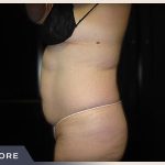 Liposuction Before & After Patient #770