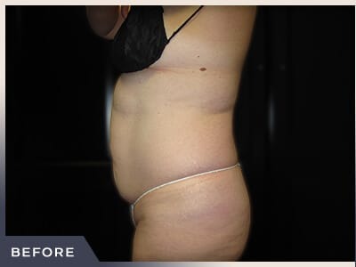 Liposuction Before & After Patient #770
