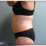 Liposuction Before & After Patient #770