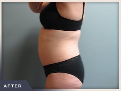 Liposuction Before & After Patient #770