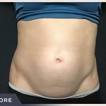 Liposuction Before & After Patient #772