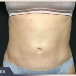 Liposuction Before & After Patient #772